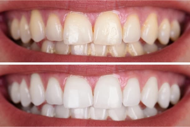 Teeth whitening before and after